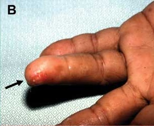 skin lesion caused by vibrio infection on a finger